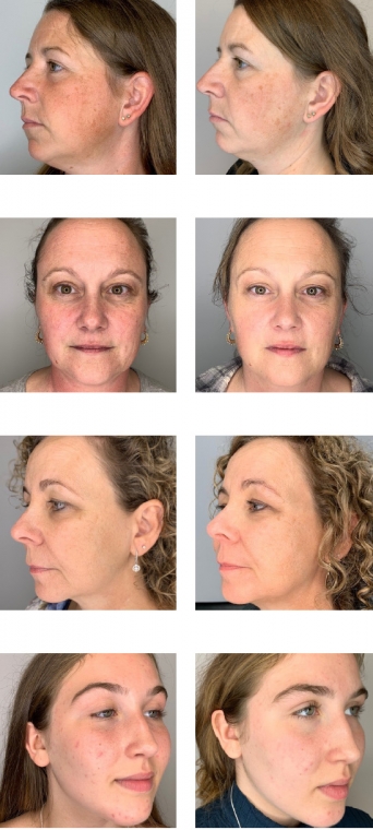 Soin Bella MD microdermabrasion infusion